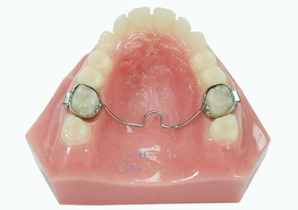 Transpalatal Arch Orthodontic Appliance