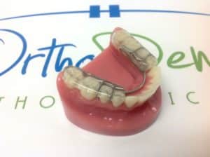 Splint Gelb Orthodontic Appliance